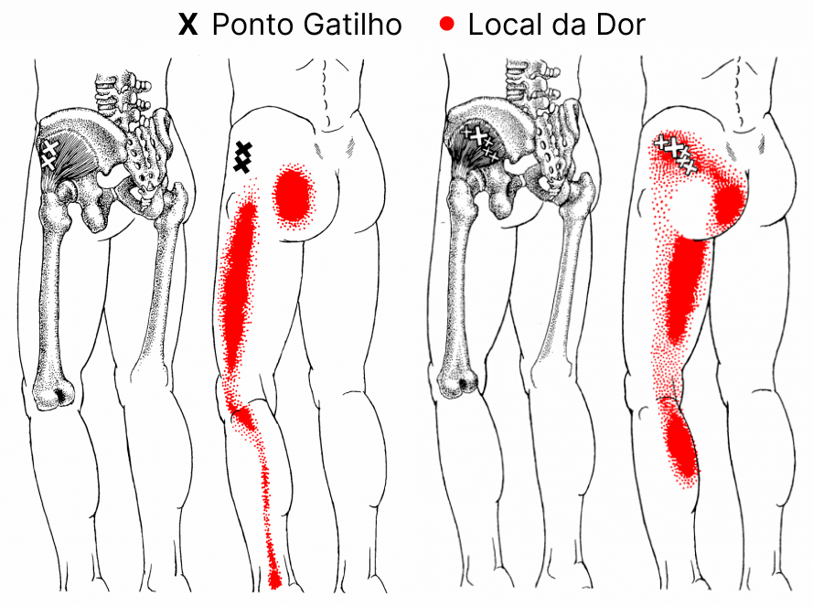 Ponto Gatilho do músculo Glúteo Mínimo.